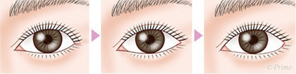 目尻切開イラスト